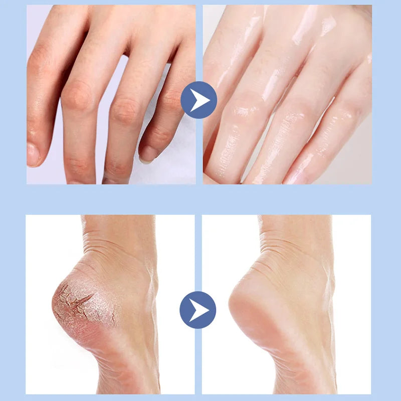 Dry and cracked heels, anti-crack cream, moisturizing cream.