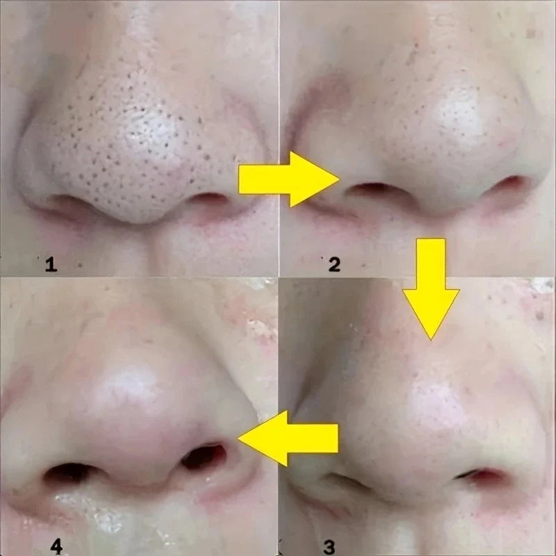 Unisex Deep Cleansing Nose Strips for Acne & Blackhead Removal