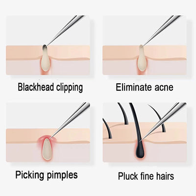 Acne Needle Blackhead Tweezers Blackhead Removal