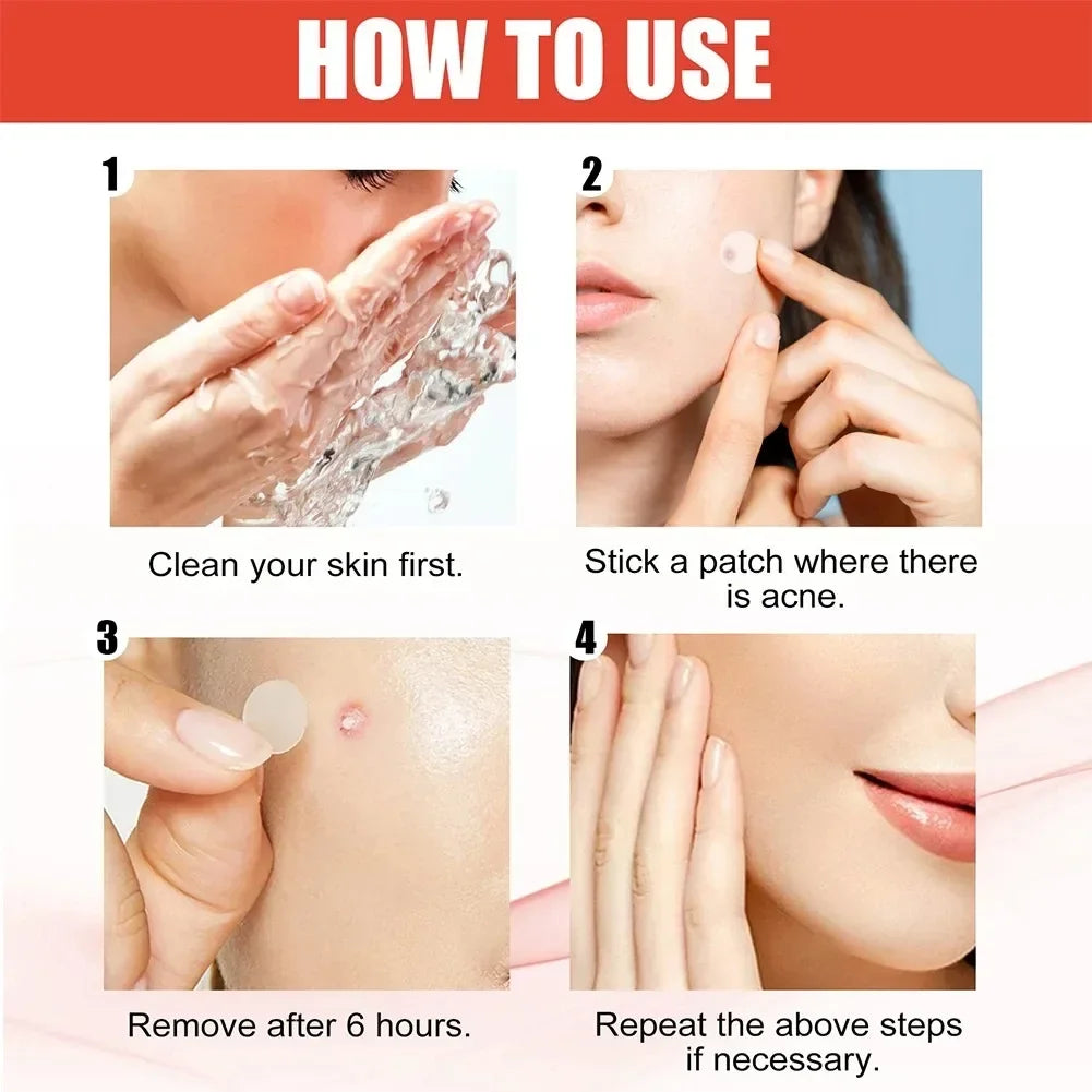 Hydrocolloid Acne Patch Facial Blemishes Pimple Marks Closed